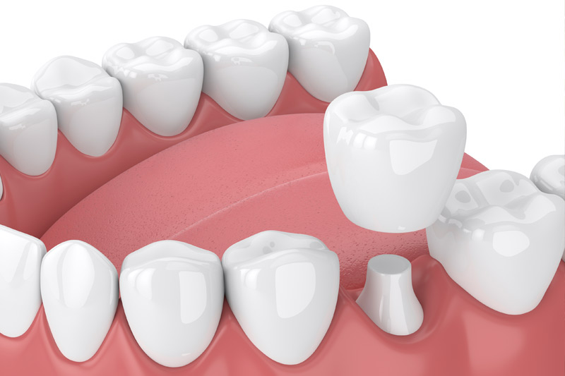 Dental Crowns in Vallejo