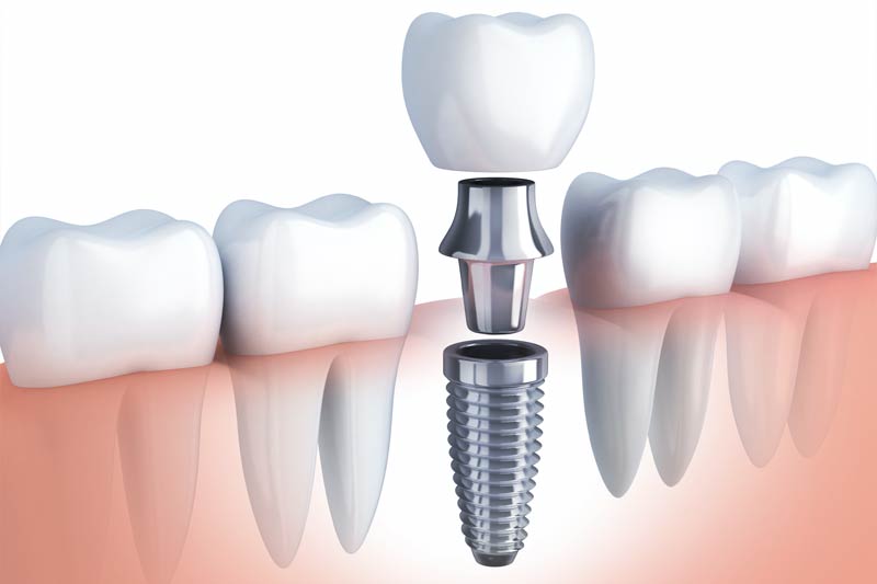 Implants Dentist in Vallejo