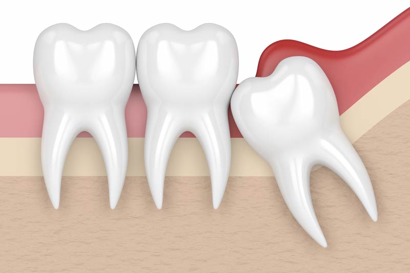Wisdom Tooth Removal in Vallejo